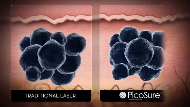 PicoSure Laser tattoo removal available at Esteem Medi Spa смотреть онлайн