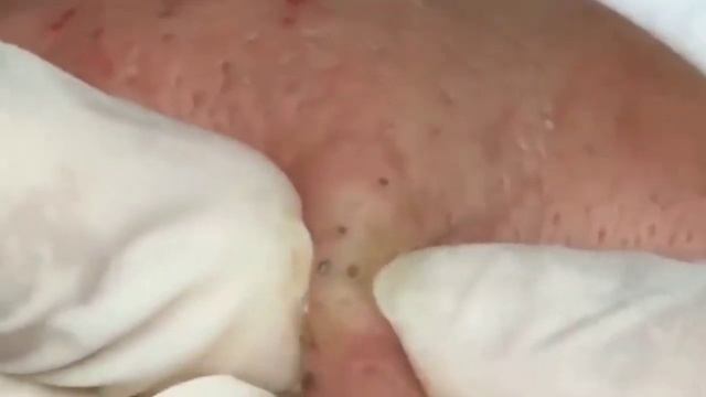 How To Treatment Blackheads On The Face Easy ##666 смотреть онлайн