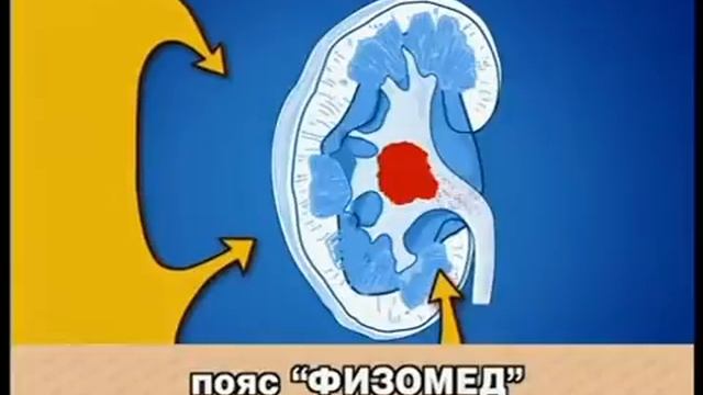 Мочекаменная болезнь. Удаление камней из почек дома. смотреть онлайн