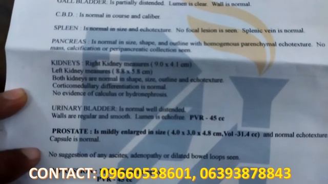 KIDNEY CYST, SIMPLE RENAL CORTICAL CYST 12×11 MM & RENAL CALCULI, KIDNEY STONE SUCCESSFULL TREATMEN смотреть онлайн