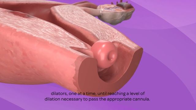 A Comprehensive Guide To Manual Vacuum Aspiration (MVA) Procedure- Ipas MVA® Plus (EN)