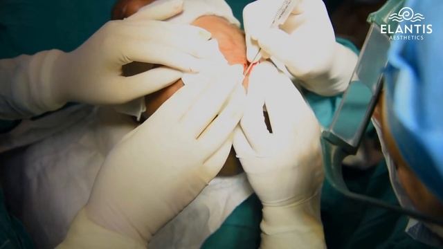 Hair Transplant Restore, Renew, Regrow YOUR HAIR | Dr. Chandni Jain Gupta смотреть онлайн