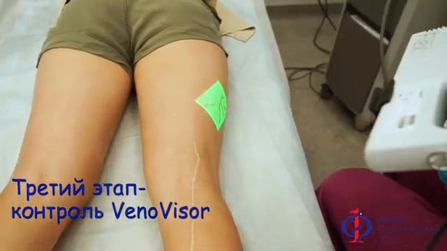 Удаление сосудистых звездочек смотреть онлайн