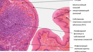 Сазонов С.В. 27. Нёбная миндалина