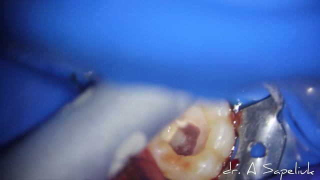 vital pulp therapy LiteTouch™ Er YAG Dental Laser смотреть онлайн