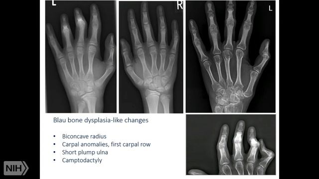 Monogenic Granulomatous Inflammatory Diseases смотреть онлайн