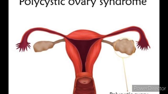 పీసీఓడీ అంటే ఏంటి? PCOD లక్షణాలు, కారణాలు and చికిత్స | PCOD in Telugu| Everything about PCOD смотреть онлайн
