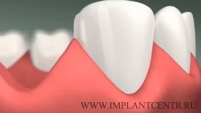 3D имплантация смотреть онлайн