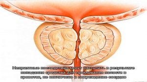 Диагноз рак простаты – операция по удалению пораженного органа