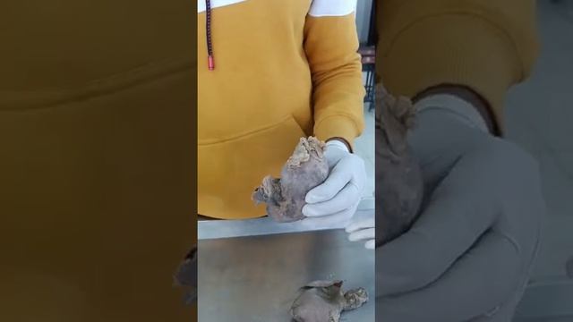 kidney anatomy смотреть онлайн