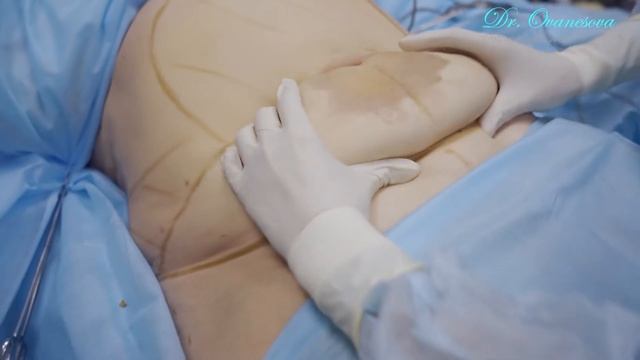 Абдоминопластика. Начало операции. Пациент Н8. смотреть онлайн