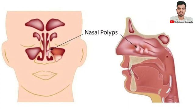 Indo German Sinus Care Tablets. Indo German Sinus Care Drops. Sinusitis. Congestion. Sneezing. смотреть онлайн