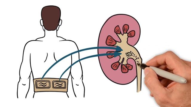 Вывод камней из почек. Безболезненно, без операций и дробления смотреть онлайн
