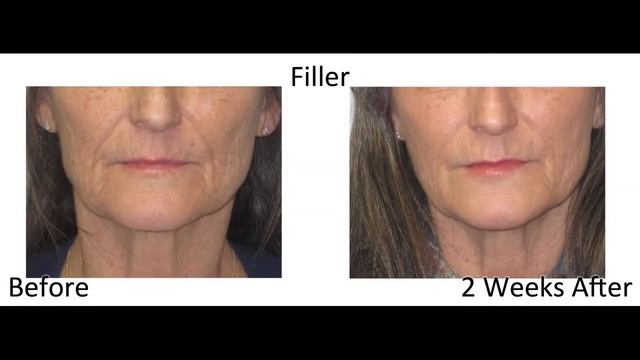 Learn More About Derma Fillers (short version) смотреть онлайн