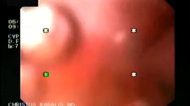 GASTROSTOMY REPLACEMENT FIRST TIME WITH FORCEP AND ARGON KARALIS 6-10-2009 ARCHOA.mpg смотреть онлайн