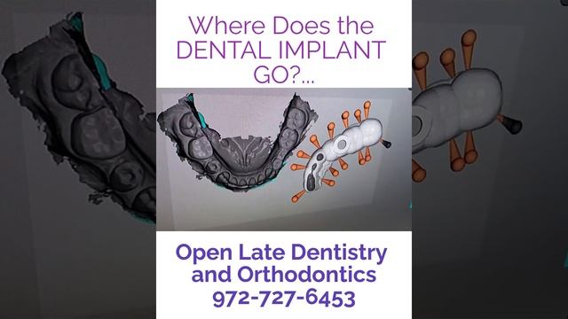 Dental Implant Planning Process Celina, TX Open Late Dentistry and Orthodontics смотреть онлайн