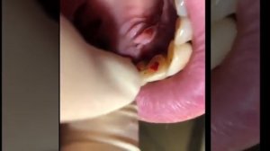 Удаление зубного нерва