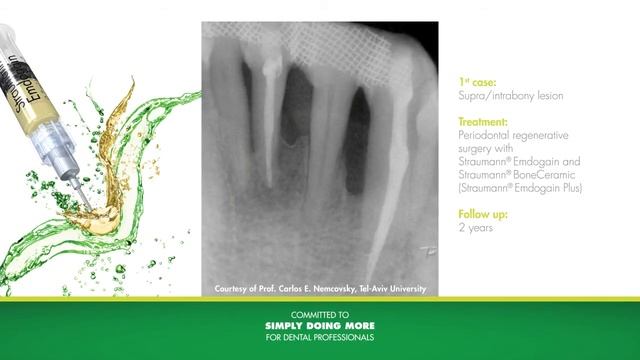 Straumann Emdogain смотреть онлайн