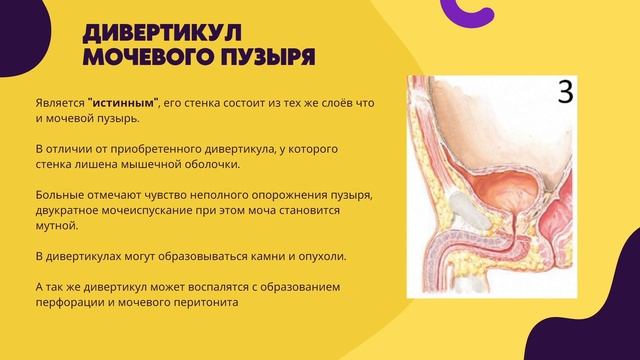 Пупочно-пузырный свищ | Урахус, что это? | Аномалии мочевого протока  | Свищи пупка Часть 2