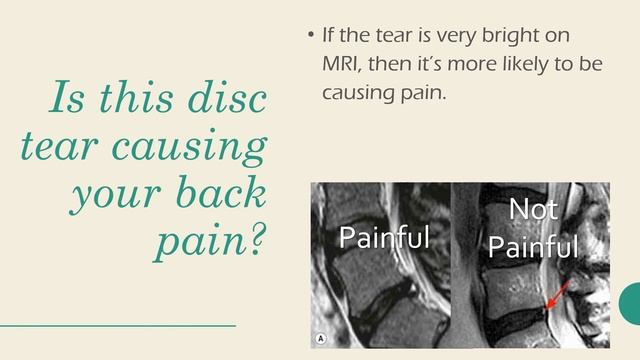 What is an Annular Tear? And How Do You Treat It Without Surgery? смотреть онлайн