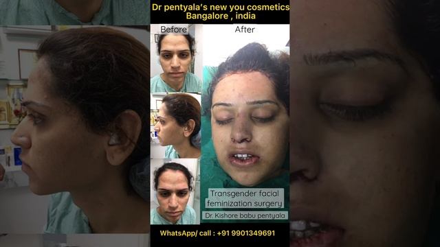 Complete face makeover from male-female FFS trans in Bangalore india #makeover #transformation #ffs смотреть онлайн