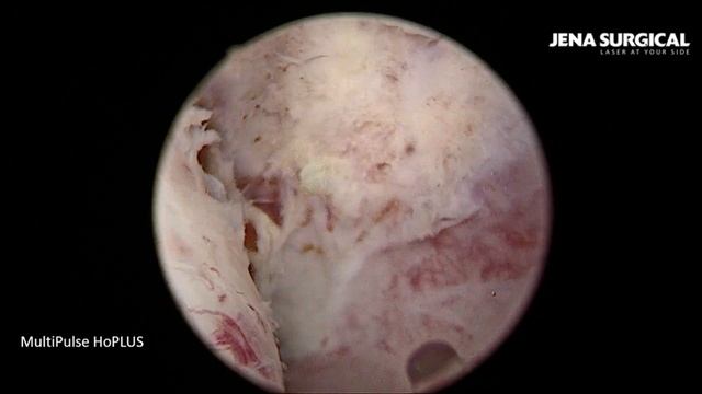 HoLEP. En-block technique. Laser enucleation of BHP 90 cc using MultiPulse HoPLUS . Artem Gonyaev. смотреть онлайн