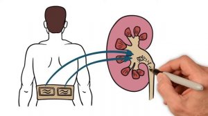 Удаление камней из почек без дробления и операции