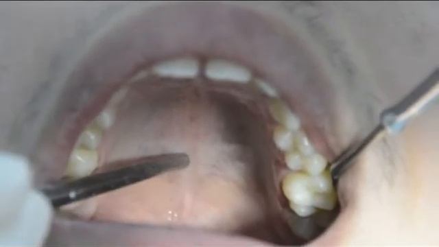 4 Intra Oral Examination смотреть онлайн