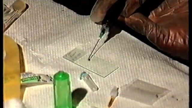 филяриозы лимфатической системы (filariasis of the lymphatic system) смотреть онлайн
