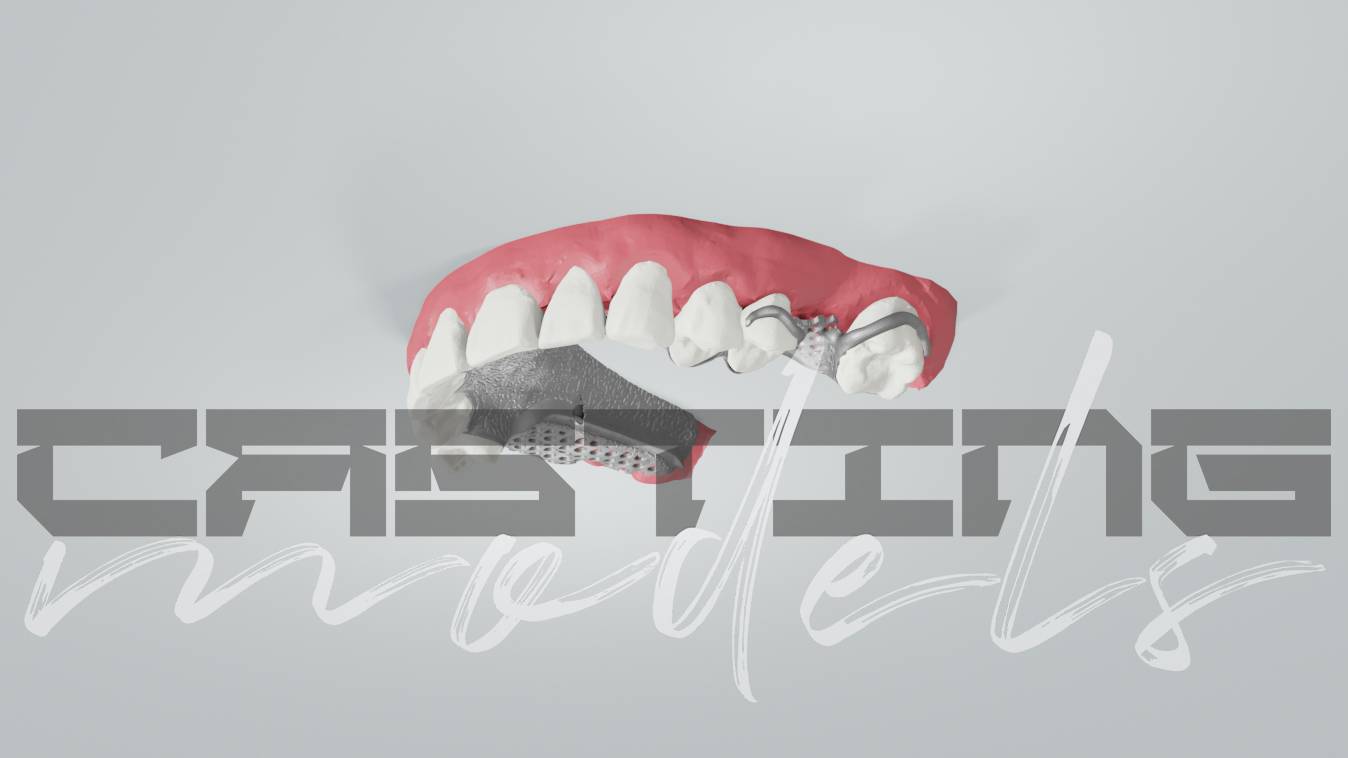 Бюгельный протез