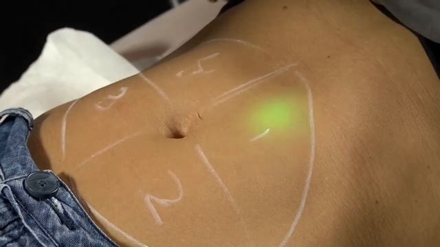 Présentation Dr Naranjo: Laser YAG CANDELA et retension cutanée смотреть онлайн