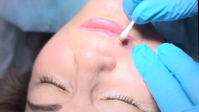 Удаление родинки двумя лазерами : СО2 и Эрбиевым/ Removal of a mole with two lasers: CO2 and Erbium смотреть онлайн