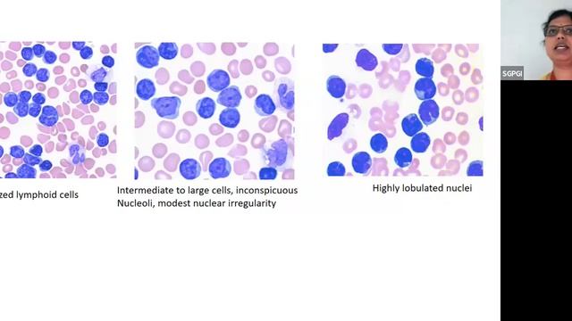 Interesting Cases 3.02.2024; Dr Mili Jain, Pathology, KGMC, Lucknow смотреть онлайн