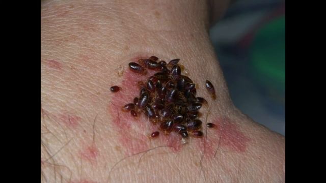 Home Remedies For Bed Bug Bites Treatment | how bed bug bites look like (A MUST SEE!) смотреть онлайн