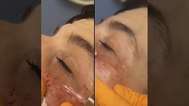 Мезотерапия против пигмента