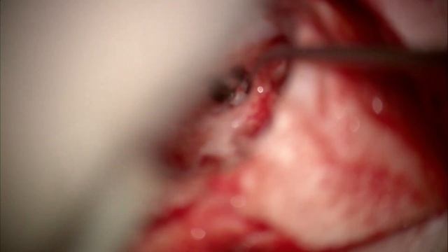 Кохлеарная имплантация (Нуротрон)/Cochlear implantation (Nurotron) смотреть онлайн