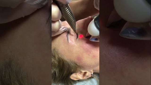 Лазерная блефаропластика безоперационная смотреть онлайн
