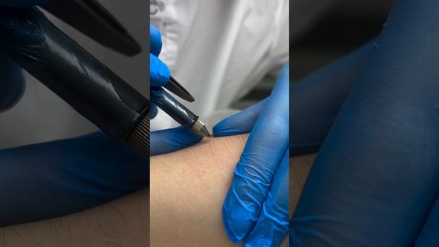 Процесс электроэпиляции⚡️
#лазернаяэпиляция #депиляция #электроэпиляция #косметология смотреть онлайн