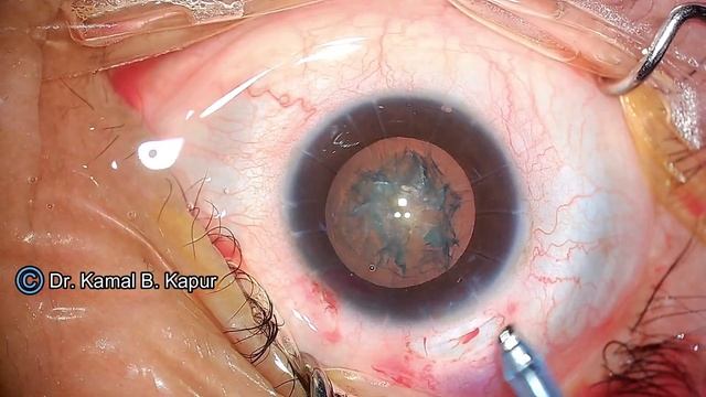 Post RK cataract surgery (Radial Keratotomy) step by step |Dr Kamal B Kapur смотреть онлайн