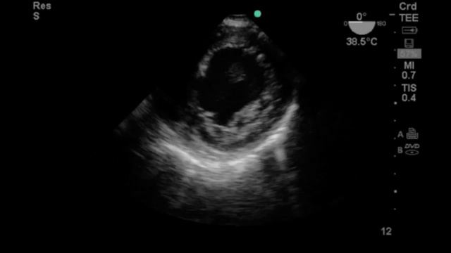 Asvide: Transesophageal echocardiography (TEE) found acute cor pulmonale in the... смотреть онлайн