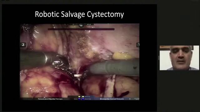 Masterclass in Minimally Invasive Radical Cystectomy смотреть онлайн