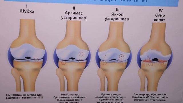 Tizza Suyaklari Yemirilishida 