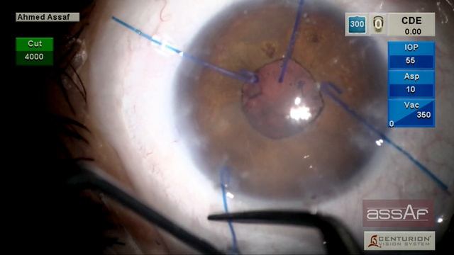 Ectopia Lentis Marfan Syndrome. Ahmed H. Assaf смотреть онлайн