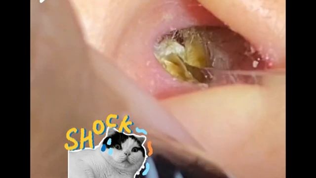 Earwax Removal. Removes fungal earwax and cleans the ears (Ep.9) смотреть онлайн