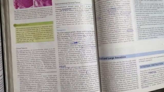 Gastro Intestinal Stromal Tumor (GIST) смотреть онлайн