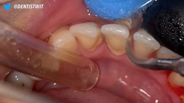 Scaling Karang Gigi  Calculus  Dentist  Dokter Gigi Tri Putra