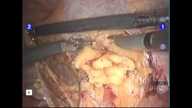 Robotic Wertheims Radical Hysterectomy - Part 1 смотреть онлайн