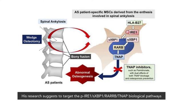 Role of HLA B27 Activation in Spinal Deformation смотреть онлайн