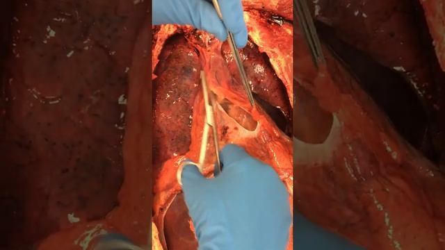 Autopsy: The Opening of the Pericardial Sac to Access the Heart смотреть онлайн