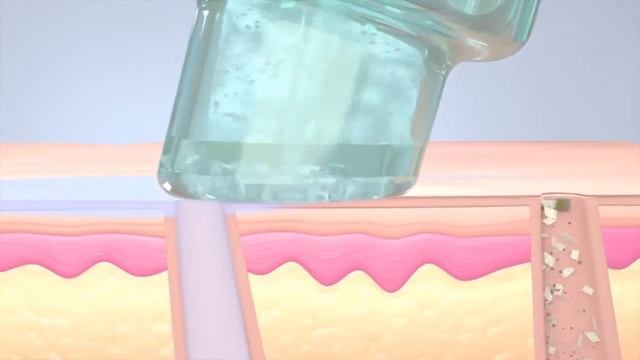 Экстракция 3 этап процедуры HydraFacial смотреть онлайн